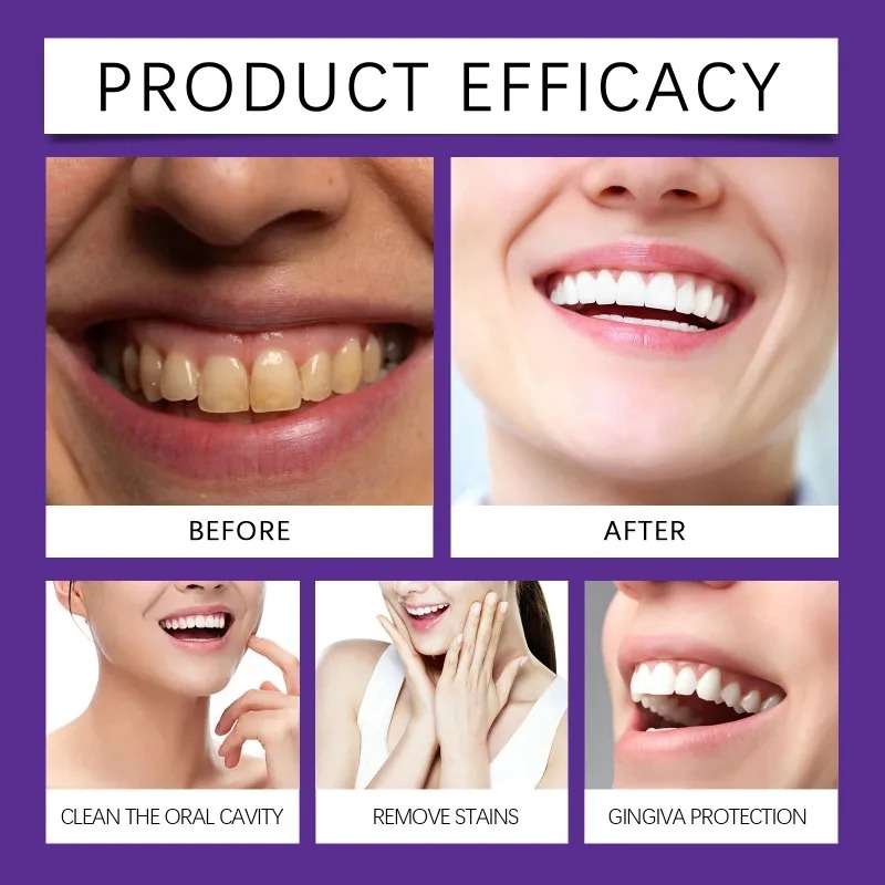 Purple Teeth Restoration Miner - Teeth Whitening Near Me ulasan dan harga